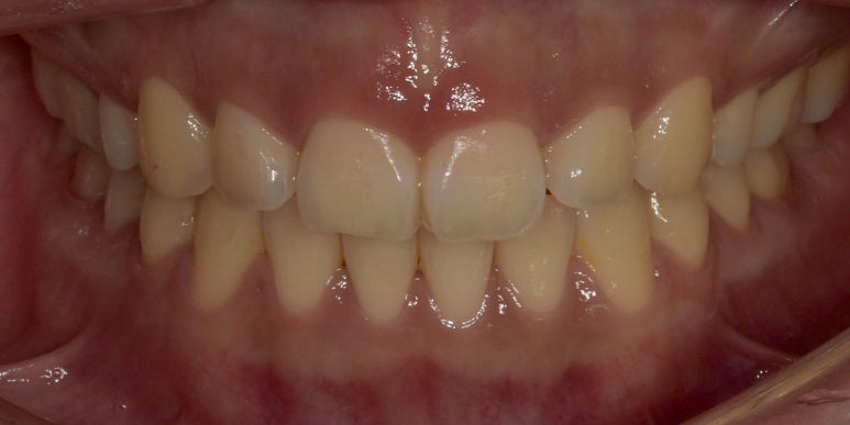 잇몸성형, OO해서 후회해요&hellip; 후회하는 이유는? 관련 이미지 5