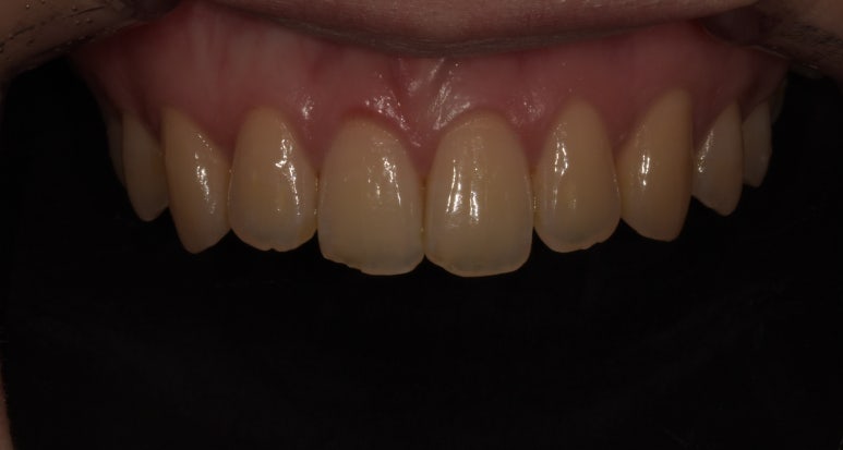 앞니성형? 라미네이트 없이 치아성형하는 방법 관련 이미지 4