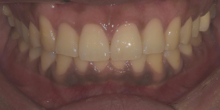 잇몸착색, 변색되어 검은 잇몸 선홍빛으로 되돌리는 방법 관련 이미지 7