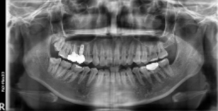 임플란트평생 사용 가능할까? 현직자가 공개합니다. 관련 이미지 4