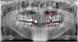 임플란트교체? 걱정되시는분들만 보세요. 관련 이미지 3