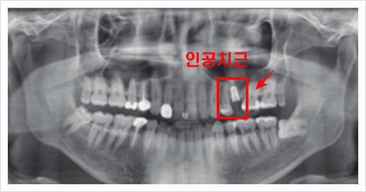 학동역치과? 전문의가 말하는 관련 이미지 4