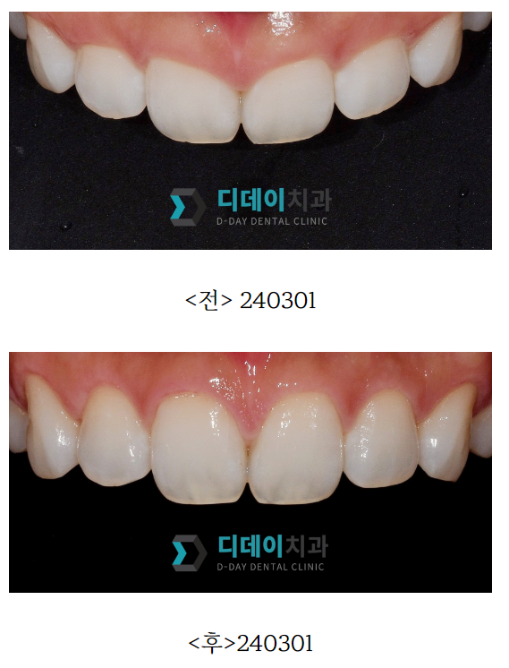 연예인 잇몸성형 방법과 비용은? 관련 이미지 1