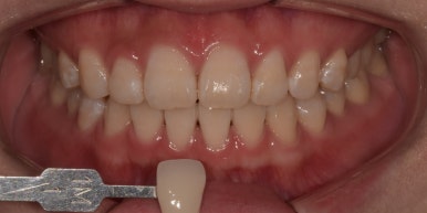 치과미백비용? 효과? A 부터 Z까지 탈탈 털어 알려드립니다. 관련 이미지 7