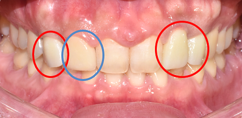 앞이빨임플란트, 내 치아처럼 감쪽같으려면? 관련 이미지 3