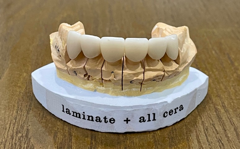 치과세라믹가격, 치과의사가 낱낱이 알려드립니다. 관련 이미지 5