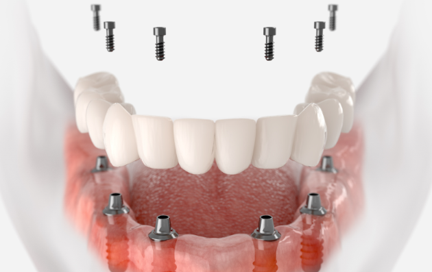 40대 전체 임플란트, 아직 젊은데 치아를 전부 발치해야만 하는 걸까? 관련 이미지 5