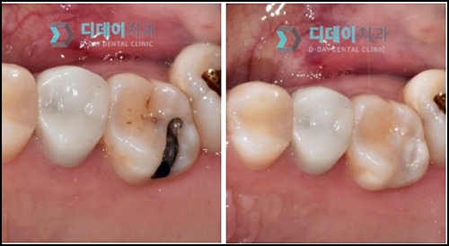 충치치료아픈가요? 치과의사가 알려드릴게요. 관련 이미지 2