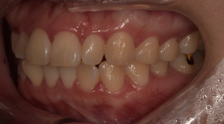 앞니브릿지와 라미네이트를 같이 해도 자연스러울까? 사례로 보여드립니다. 관련 이미지 5