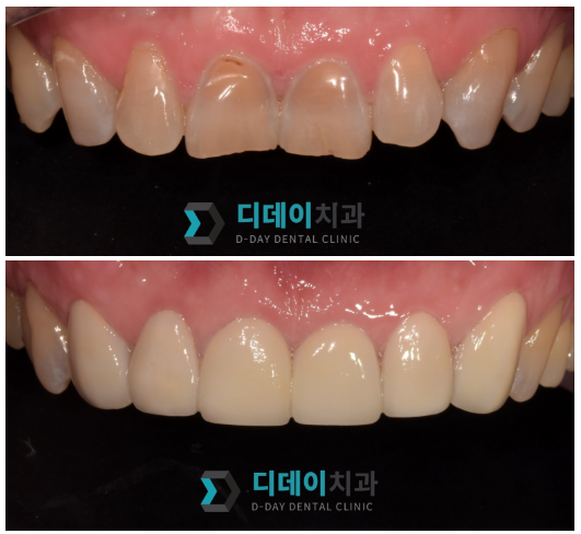 한티역치과, 라미네이트 잘하는 곳 찾기 힘들죠? 의사가 고르는 기준 공개 관련 이미지 3