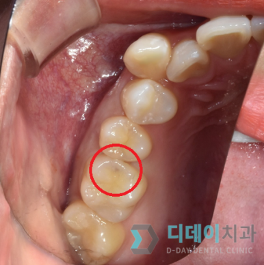 어금니충치치료비용, 병원마다 차이나는 진짜 이유 2가지 관련 이미지 6