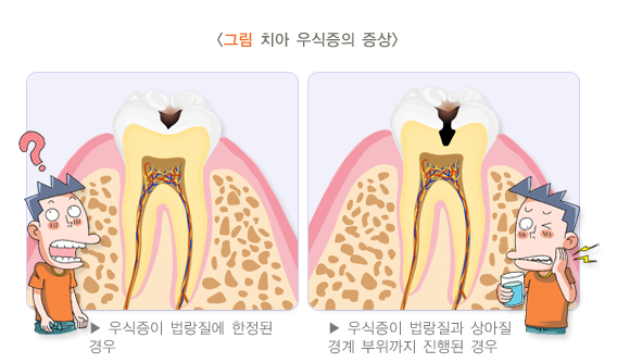 썩은앞니, 빠르게 치료하지 않으면 큰일 납니다 관련 이미지 4