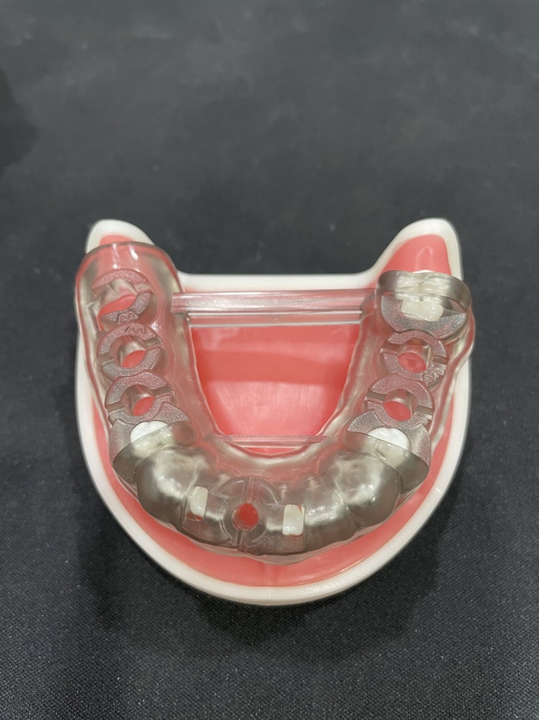 네비게이션임플란트가격, 일반 임플란트보다 비싼 이유? 관련 이미지 4