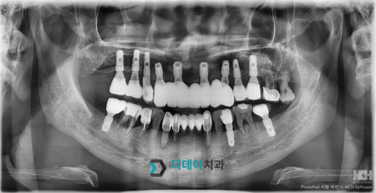 개포동치과, 임플란트 잘하는 곳의기준 3가지 〈필독〉 관련 이미지 4