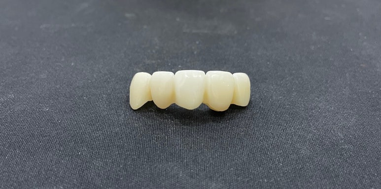 앞니브릿지교체? 브릿지를 크라운으로 교체 가능할까? 관련 이미지 2