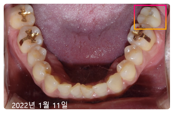 압구정 임플란트? 광고글 보다가 지친 분들만 <필독> 관련 이미지 8