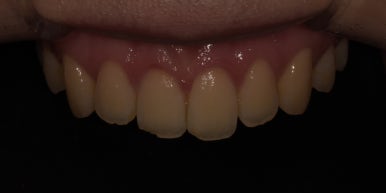 치아다듬기, 만만하게 생각할 치료는 절대 아닙니다. 관련 이미지 4