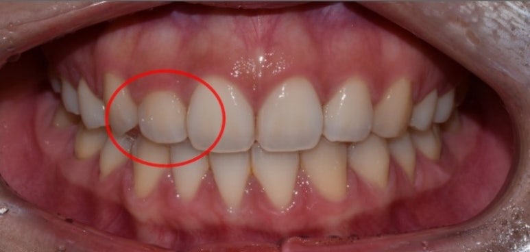 잇몸성형가격? 비용, 주의사항, 치료 후기 공개 관련 이미지 5