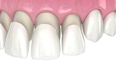 Laminates: Do They Really Last a Lifetime? Lifespan and Care Tips image 1