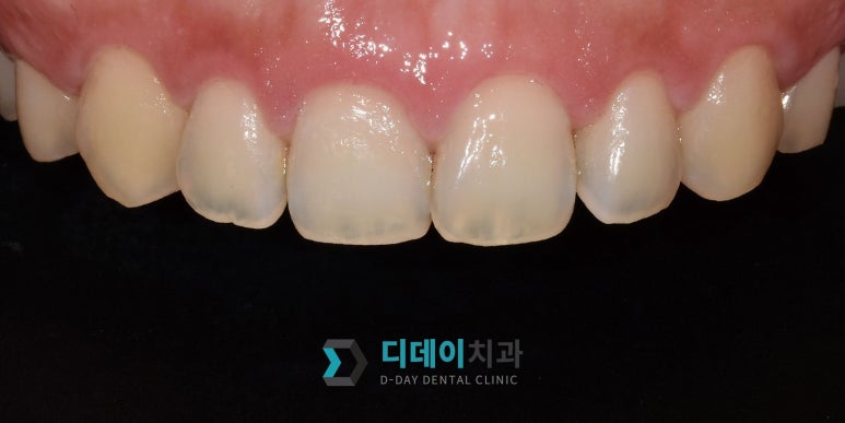 웃을 때 잇몸이 많이 보인다면, 몰라서 못하는 이것 관련 이미지 4