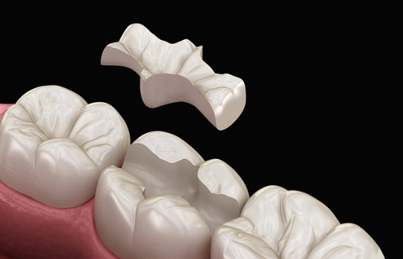대치동 레진과 인레이 치료 어떤 경우에 사용할까 관련 이미지 4