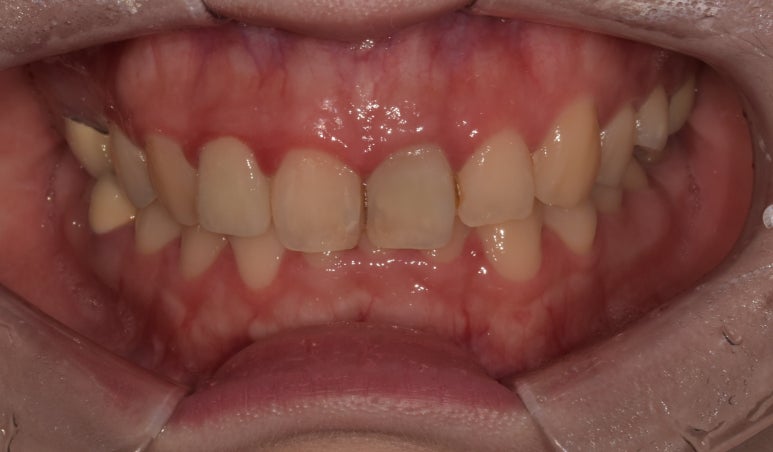 치아 검은색 치료하는 실활치미백, 방법과 비용까지 한번에 정리! 관련 이미지 3
