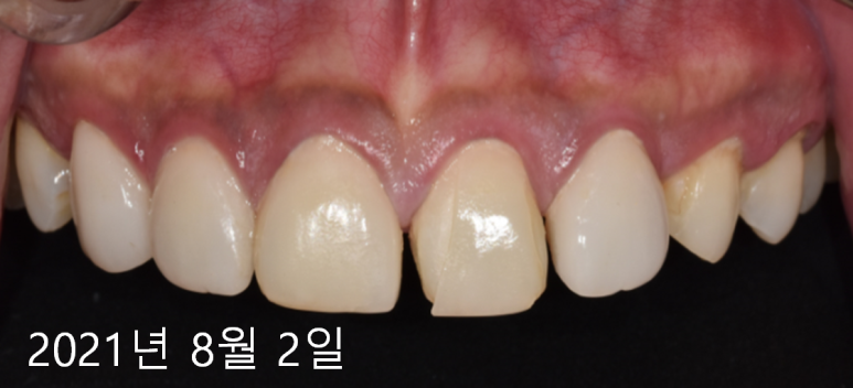 라미네이트떨어짐, 깨짐의 진짜 원인은 따로 있다? 관련 이미지 2