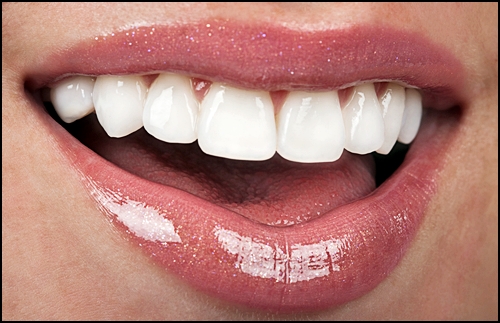 라미네이트재시술? 후회하지 않으려면 확인하세요. 관련 이미지 3