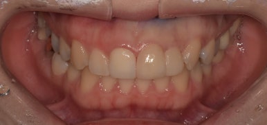 라미네이트 전후사진과 치료비용까지 숨김없이 알려드립니다. 관련 이미지 7