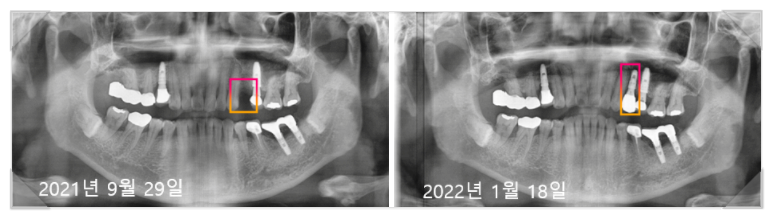 임플란트가격싼곳? 비용보다 중요하게 봐야하는 "이것" 관련 이미지 10