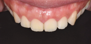 잇몸착색? 실제 치료 사례 보여드립니다. 관련 이미지 3