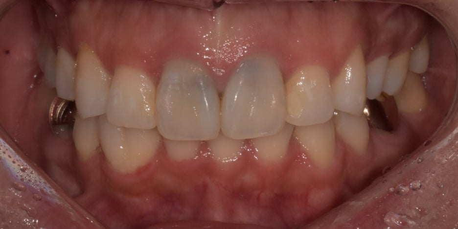 프로필 촬영 전 치아미백 꼭 필요할까요? 관련 이미지 7