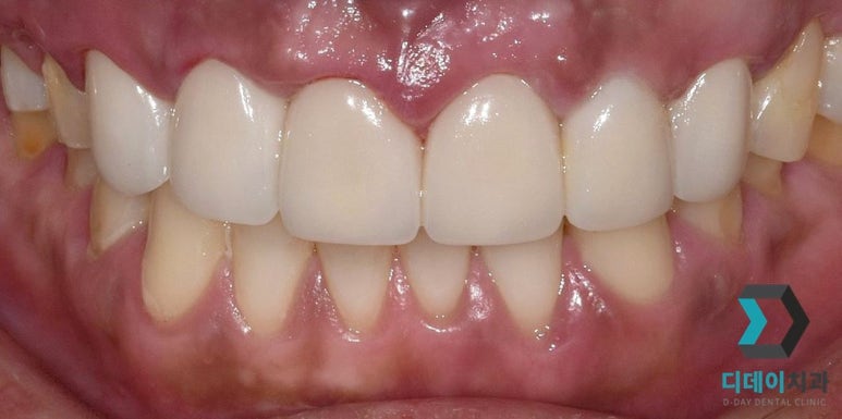 라미네이트후기, 치료사례만 모아 보여드립니다 관련 이미지 6