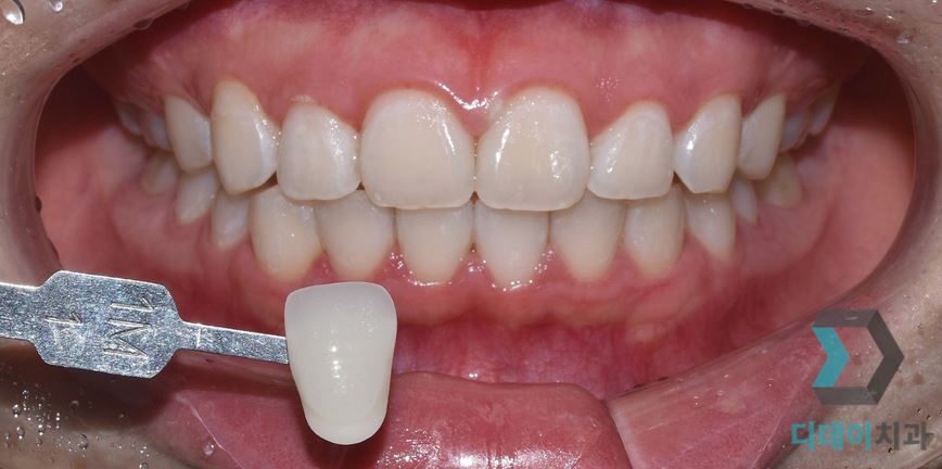 치아미백 횟수? 병원? 시술 전 알면 좋은 체크리스트 관련 이미지 5
