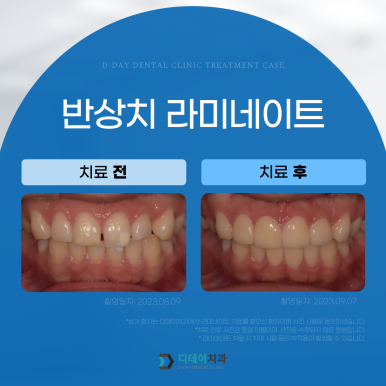 앞니성형, 종류별 가격과 전후사진까지 완벽 정리 관련 이미지 14