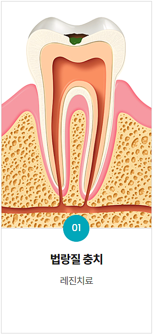 충치치료 기간, 과정, 비용까지 전문의가 알려드립니다. 관련 이미지 7