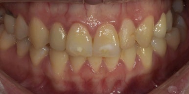 치아성형, 앞니 모양 획기적으로 바꾸는 방법이 있다? 관련 이미지 10