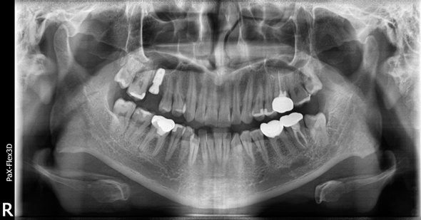 상악동거상술비용, 투명하게 공개합니다 관련 이미지 6