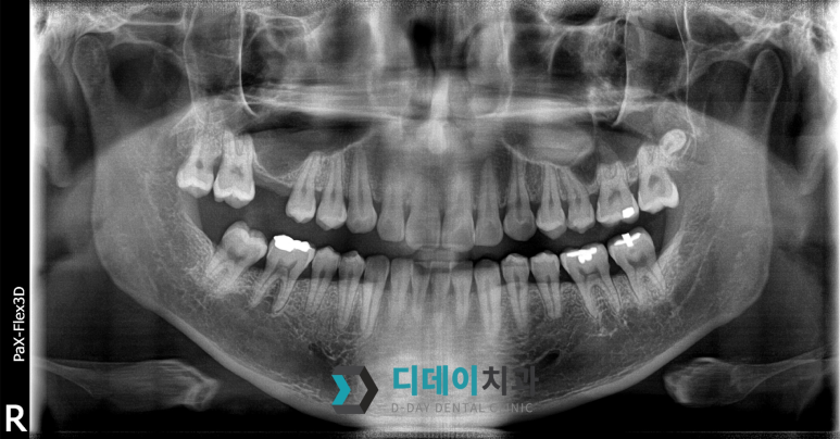 선릉역치과 임플란트 잘하는 곳? 의사라면 딱 이것만 확인합니다 관련 이미지 5