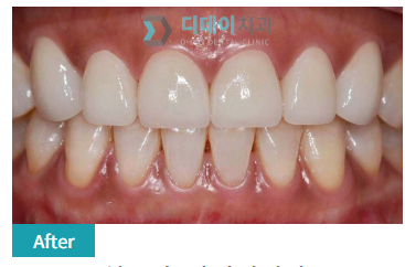 면접 전 치아미백, 꼭 알고 받으세요. 관련 이미지 5