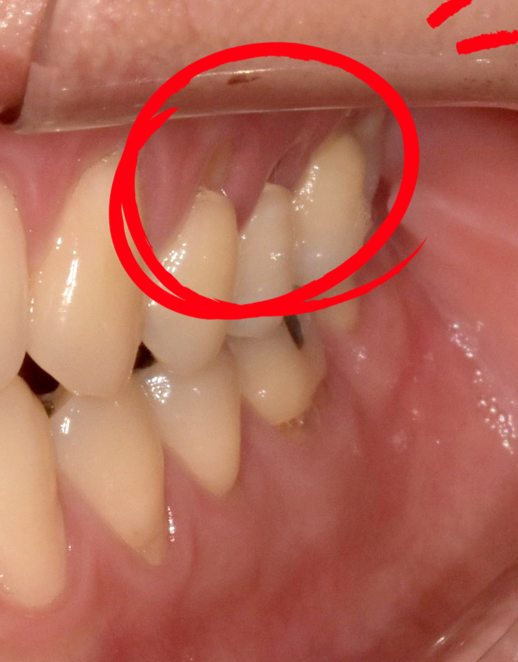치아레진? 앞니, 치경부, 어금니 각 부위별 치료사례&비용 관련 이미지 8