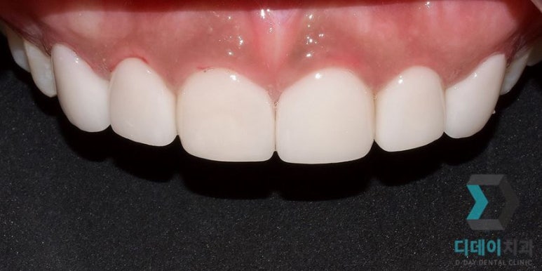 라미네이트후기, 치료사례만 모아 보여드립니다 관련 이미지 8