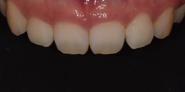 잇몸성형후기, 사례가 없어 고민하셨던 분만 관련 이미지 7