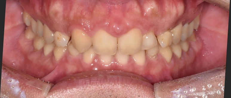 네비게이션임플란트, 무조건 성공하는 것은 아닌 이유? 관련 이미지 6