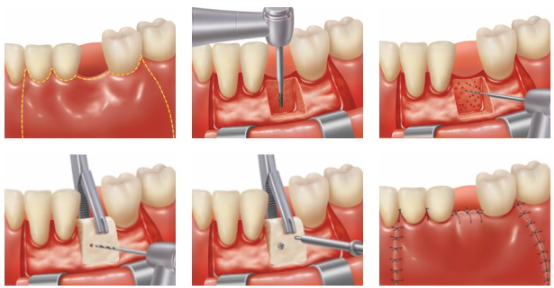 치조골 증대술 , 베테랑들도 어려워하는 이유 관련 이미지 5