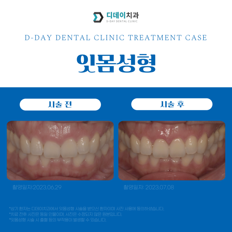잇몸성형, 환자를 돌려보내는 치과가 있다? 관련 이미지 6