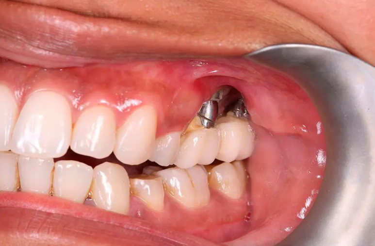 Yeoksam-dong Dental Clinic Implants, Why One Mistake Can Lead to a Lifetime of Regret 〈Written by the Director〉 image 3