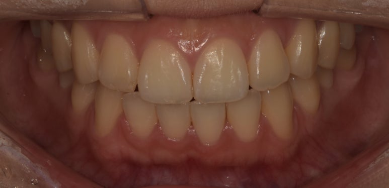 치과치아미백, 전후사진과 치료비용이 궁금하다면? 관련 이미지 7