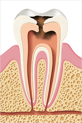 지르코니아크라운 가격만 보고 치과 선택하지 마세요 관련 이미지 2