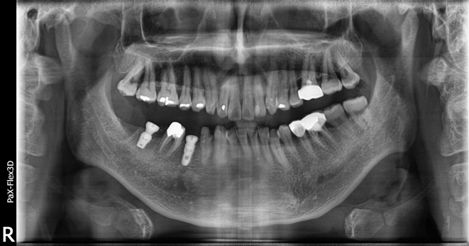 어금니임플란트, 당일식립한 사례부터 비용까지 관련 이미지 7